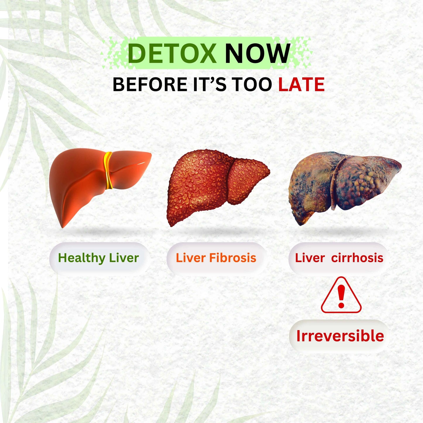 Liver Ultra detox - Best Ayurvedic medicine for fatty liver (Grade 1, 2 & 3)