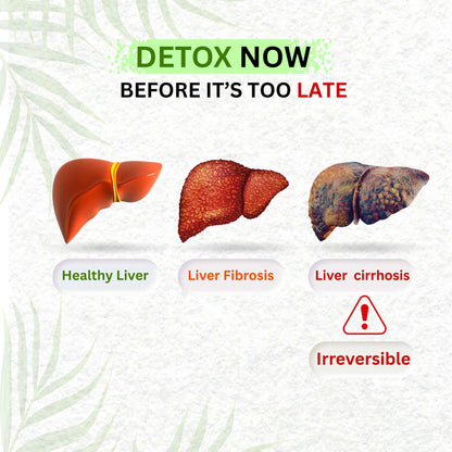 Liver Ultra detox - Best Ayurvedic medicine for fatty liver (Grade 1, 2 & 3)
